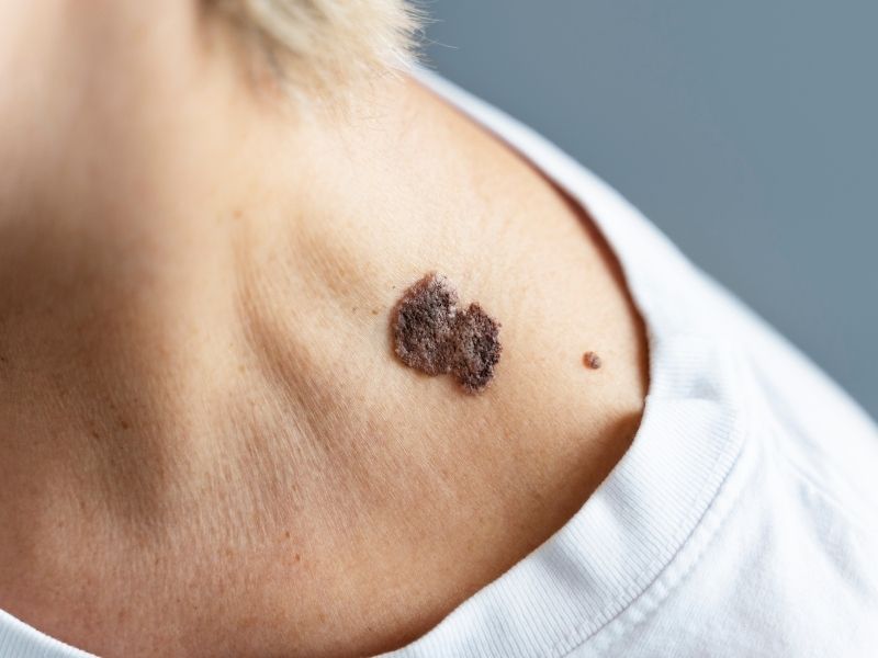 sigil-kondiloma-akuminata