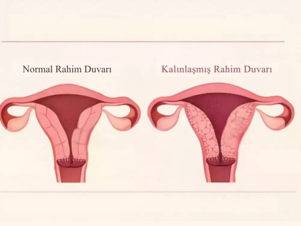rahim-duvari-kalinlasmasi